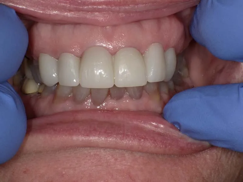 After photo case 3