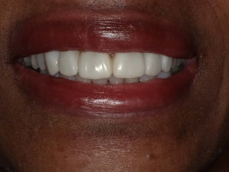 After photo case 5